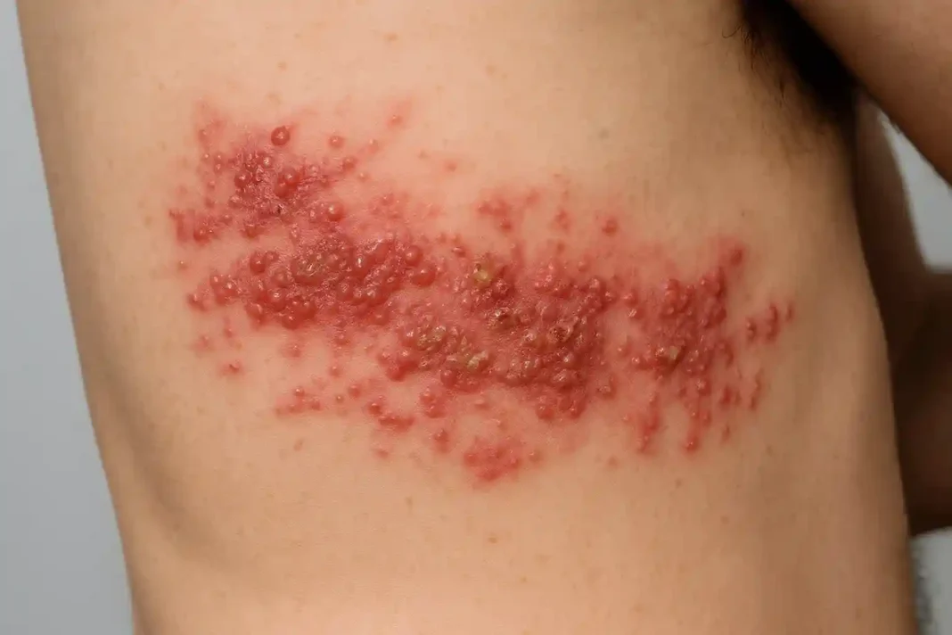 gürtelrose-herpes-zoster Gürtelrose Hautausschlag und Bläschen erkennen